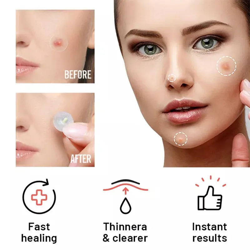 Chin Acne Day &amp; Night Repair Patch